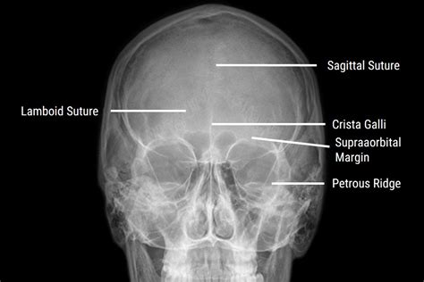 nose stl x ray meaning|Imaging the Paranasal Sinuses and Nasal Cavity .